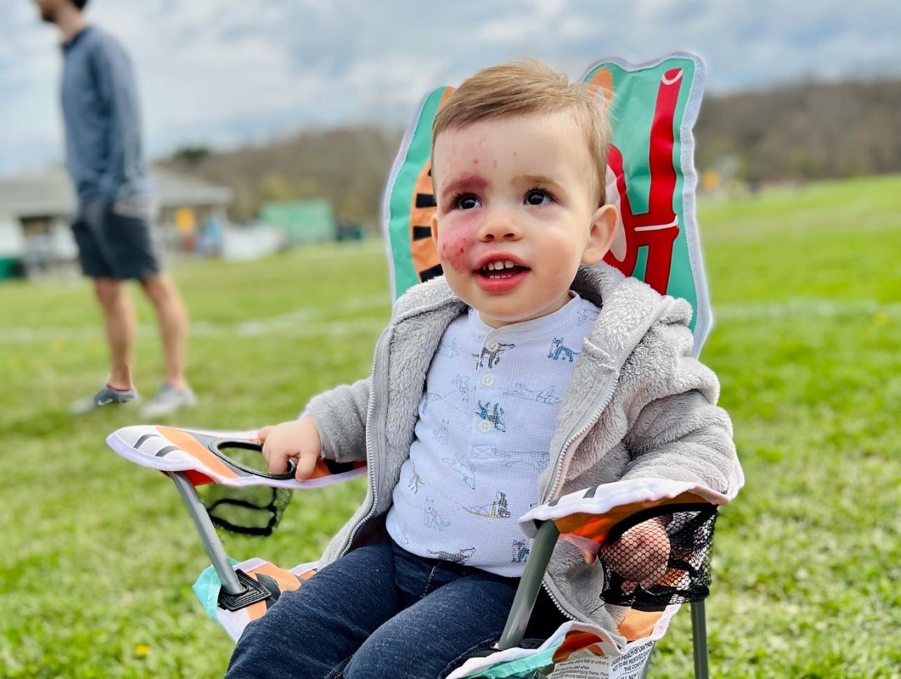 A photo of Calvin, a young Kennedy Krieger patient with Sturge-Weber Syndrome