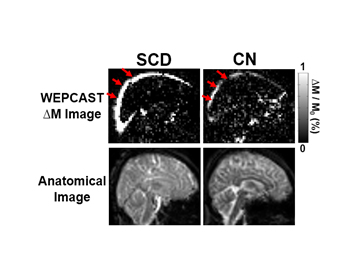 WEPCAST) MRI