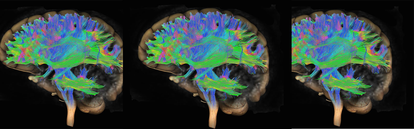 Three MRIs of brain. 