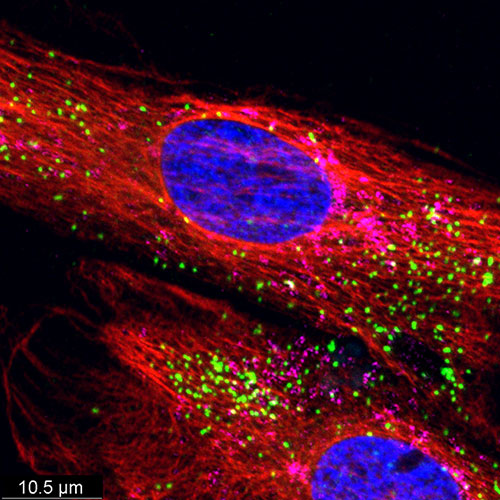 ALD patient fibroblasts