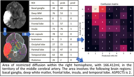 Area of restricted diffusion within the right hemisphere, with 166.412ml, in the territory of the middle cerebral artery. The area involves the following brain regions: basal ganglia, deep white matter, frontal lobe, insula, and temporal lobe. ASPECTS is 2