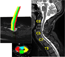 dti_spinalcordsmall.gif