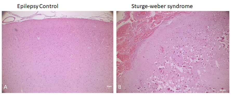 Side by side comparison of epilepsy control and Sturge-weber syndrome brain tissue.