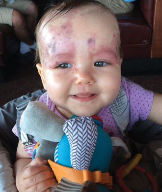 A smiling baby with port wine-colored birthmarks across her face.