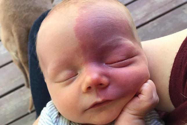 An infant with Sturge-Weber syndrome takes a nap while being held. 