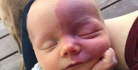 Article about Sturge-Weber syndrome research