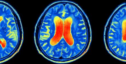 An MRI of brain activity.