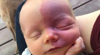 An infant with Sturge-Weber syndrome takes a nap while being held. 