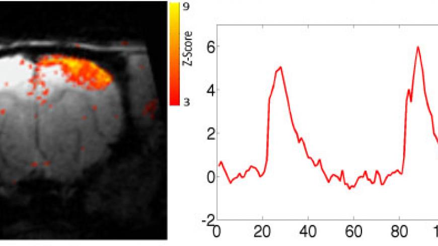 Functional MRI Z-maps